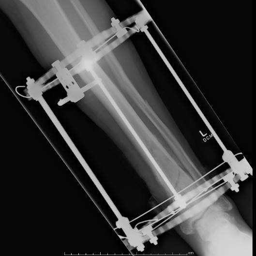 Distal tibial infected non union with Ilizarov AP